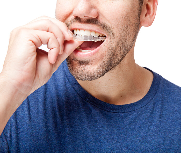 man inserting clear aligners onto his teeth