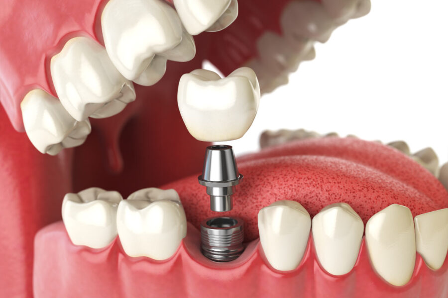 Illustration of a dental implant replaces a missing tooth in a mouth