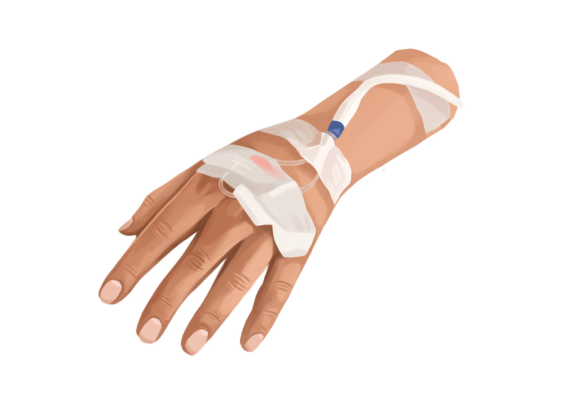 Technical graphic illustration of IV for the dental sedation option of IV sedation.