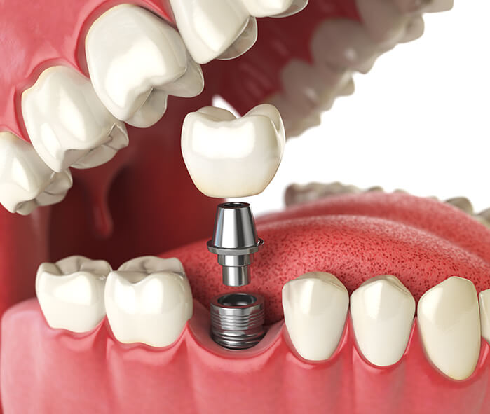 illustration of a dental implant