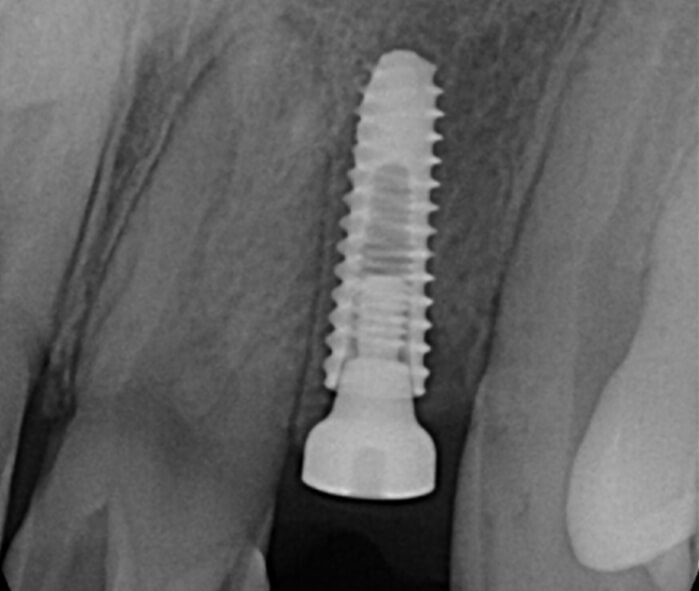 x-ray of a dental implant