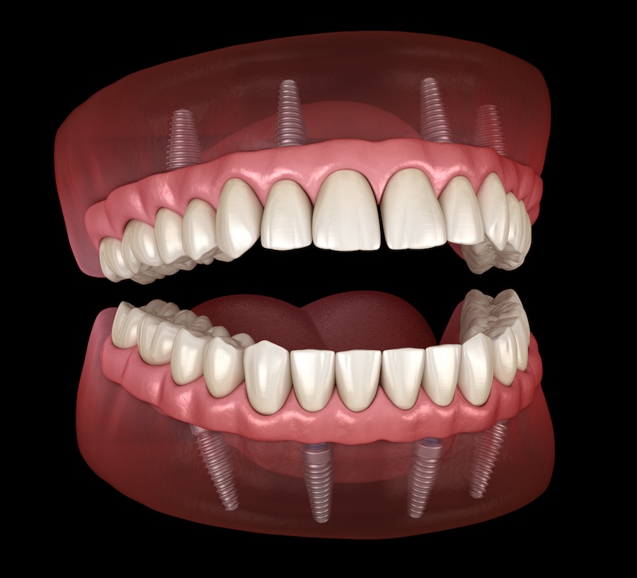 illustration of all-on-4 dentures, implant supported dentures