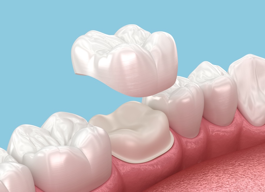 dental crowns, dental caps