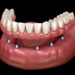 implant dentures on mandible, how to clean implant-supported dentures