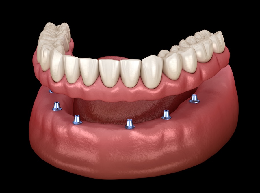 implant dentures on mandible, how to clean implant-supported dentures