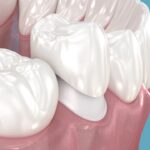 same day dental crown on premolar tooth