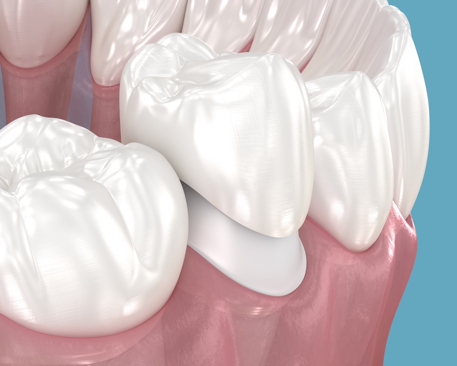 same day dental crown on premolar tooth