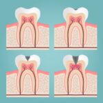progression of a dental cavity, which can happen after delaying dental treatment