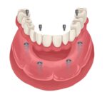 implant supported dentures, all on 4 dentures