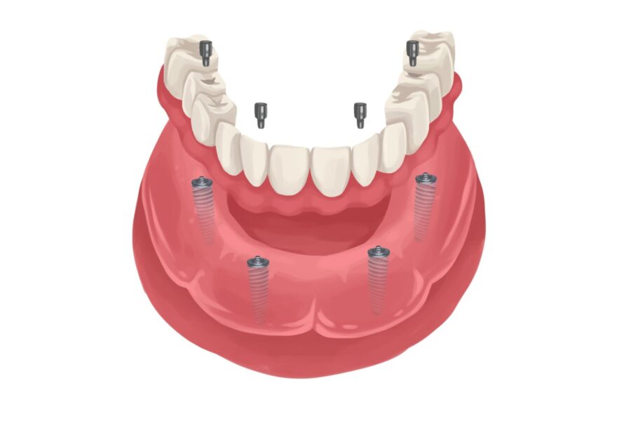 implant supported dentures, all on 4 dentures