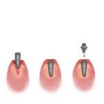 dental implant process timeline