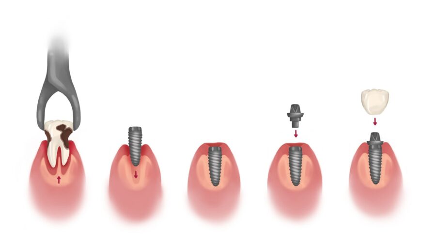 dental implant process timeline