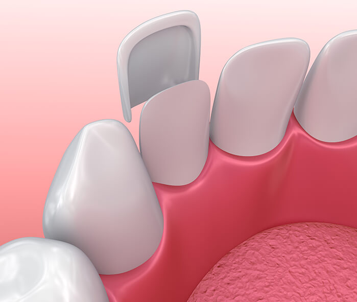 illustration of a dental veneer