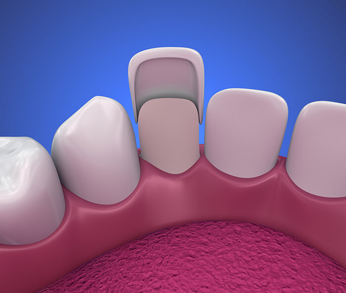 illustration of a dental veneer